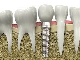 Implante-dental-2