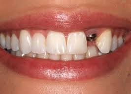 Implante-dental-3