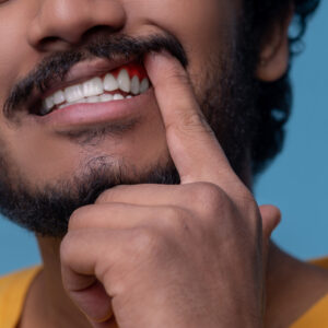 adult man showing his periodontal disease before t 2021 12 16 20 42 29 utc (1)