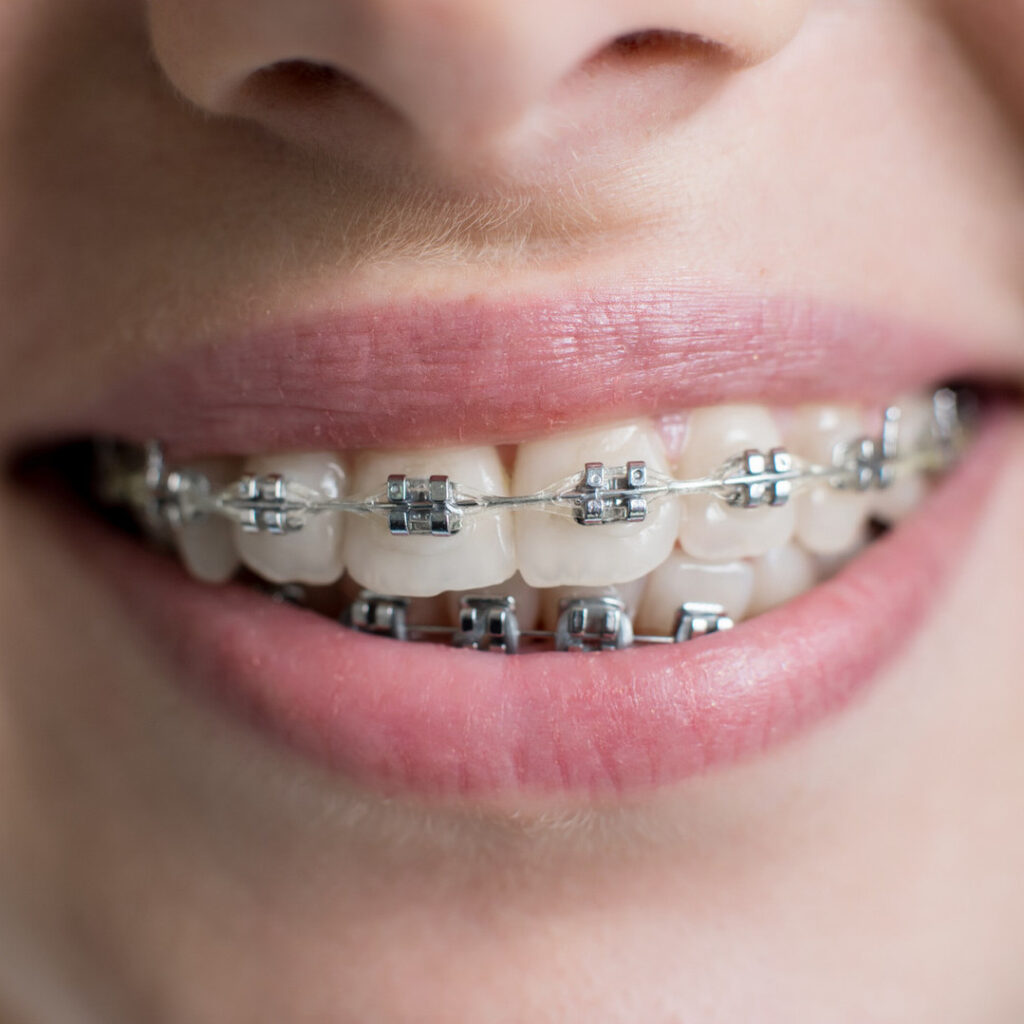 close up shot of teeth with braces female patient 2022 05 11 00 33 40 utc
