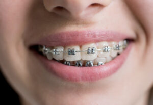 close up shot of teeth with braces female patient 2022 05 11 00 33 40 utc