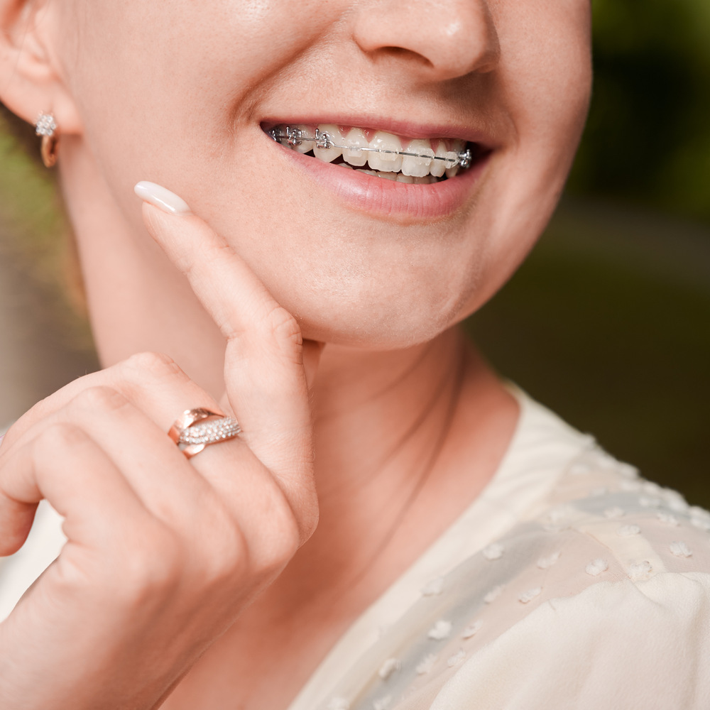 female smile with orthodontic braces on teeth 2022 05 30 22 51 40 utc (1)
