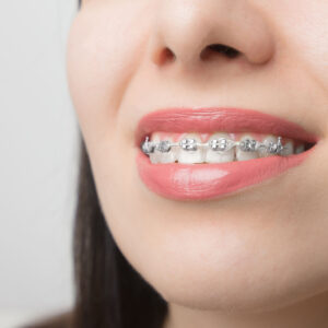 young woman smile with dental braces brackets on 2021 10 12 23 20 05 utc (1)